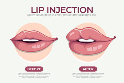 lip-botox-before-and-after